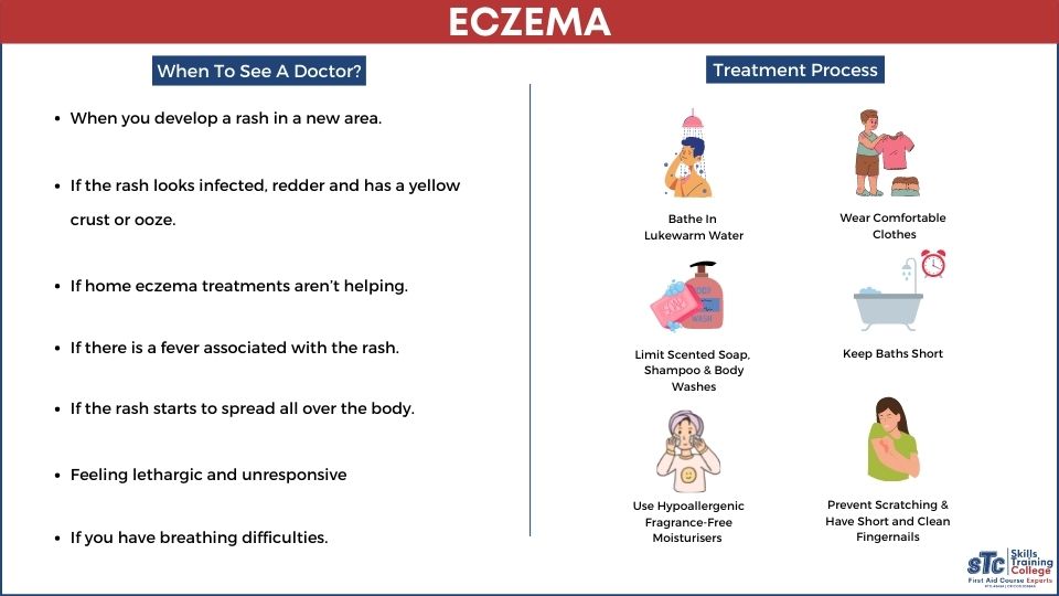 Treatments for Eczema