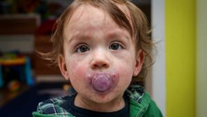 child care Allergies and anaphylaxis
