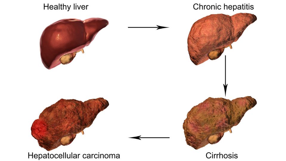 Complications Of Fatty Liver Disease