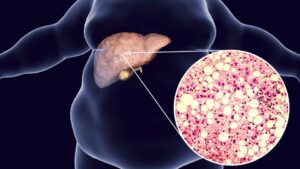 Fatty Liver Types, Causes, Complications And Treatment