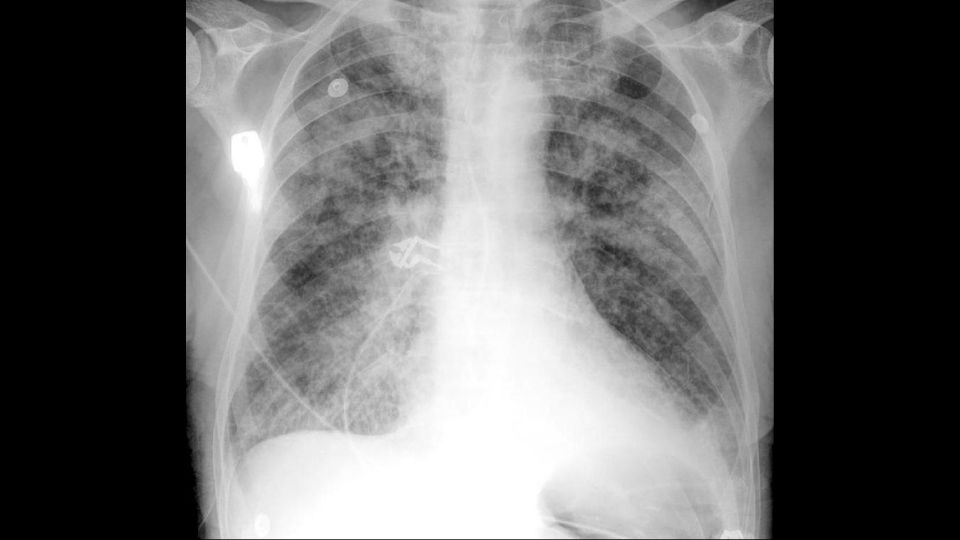 Pulmonary Oedema