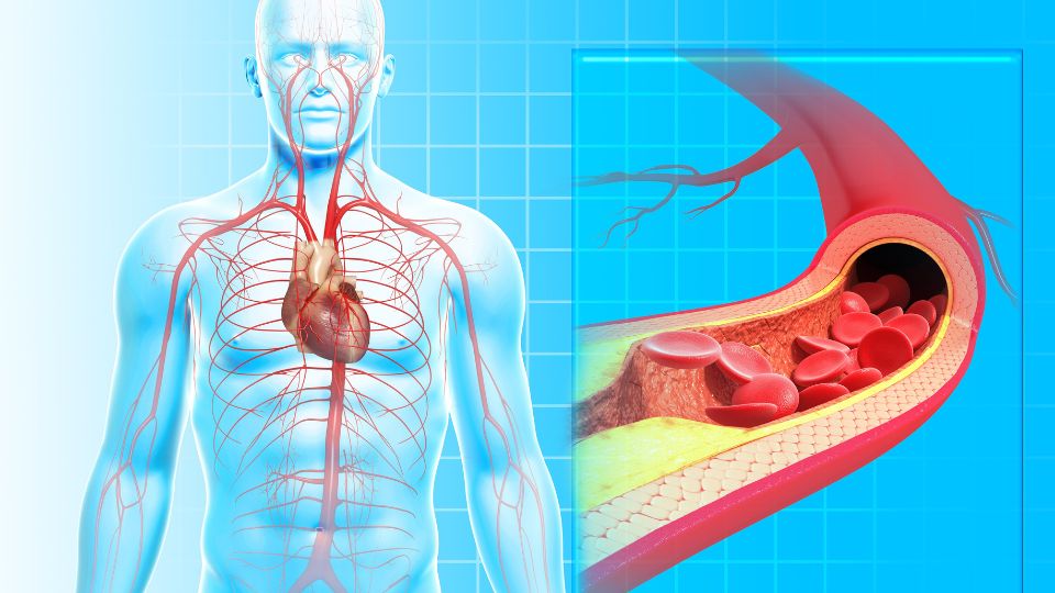 The Complications Of Atherosclerosis