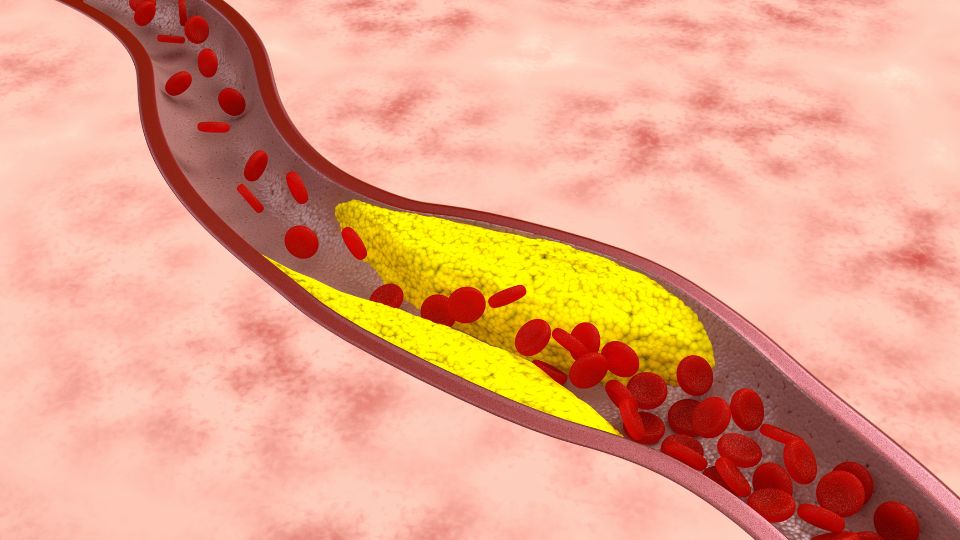 What Is Atherosclerosis