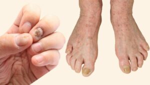 Fungal Infections learn the types, symptoms and treatments